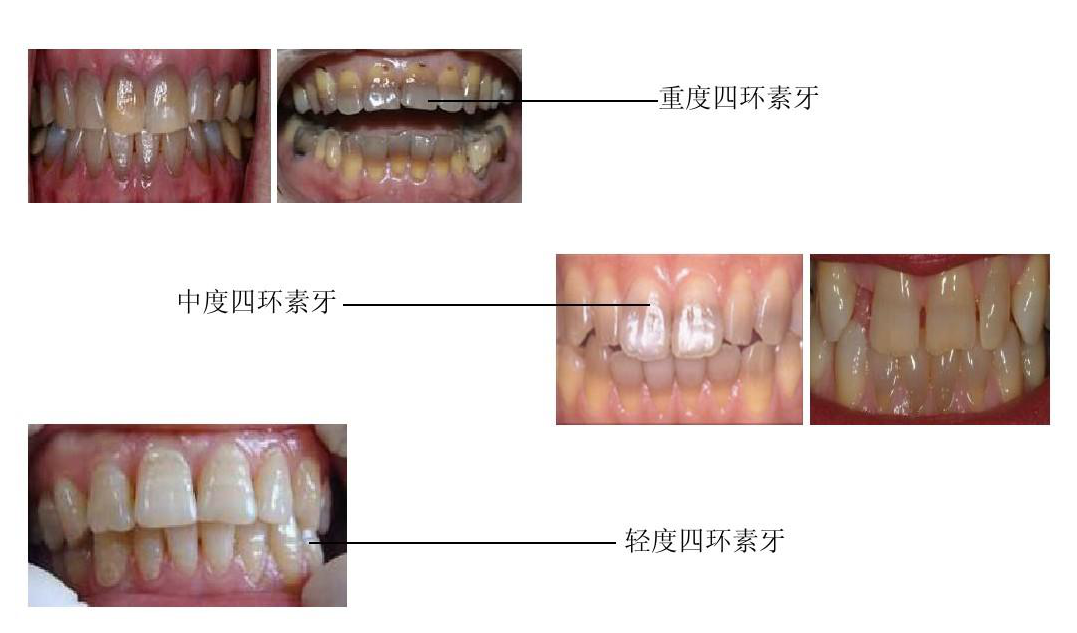 四环素牙有什么症状?